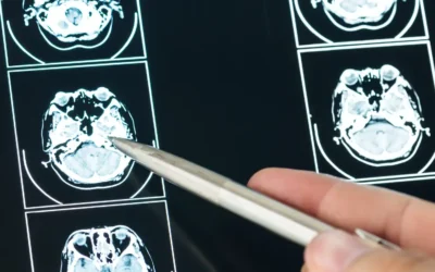 Er is na een hersenschudding niets te zien met MRI, maar toch heeft u nog klachten